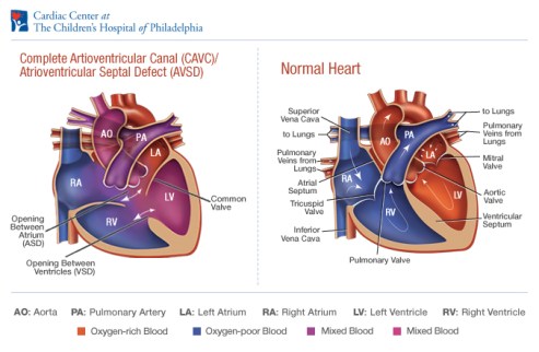 sidebyside_cavc-avsd